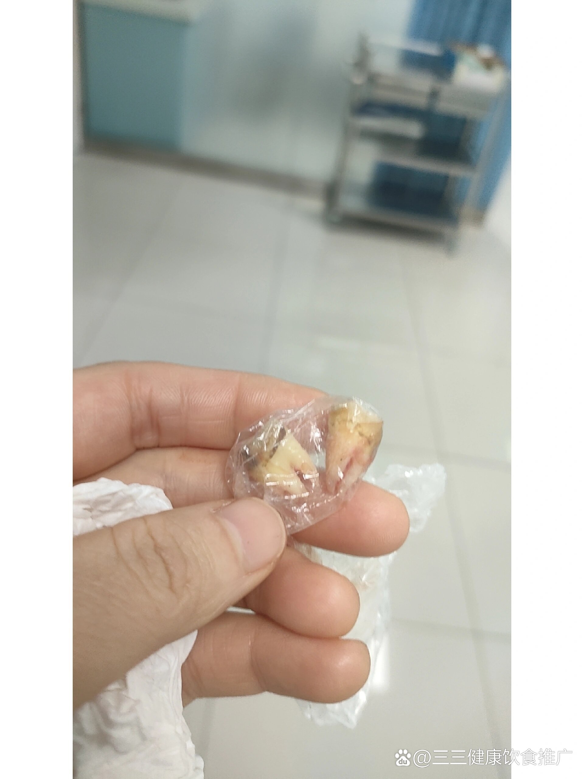 拔智齿了,右边上下两颗,下面的的龋齿了,烂了一个洞,上面的也黑了