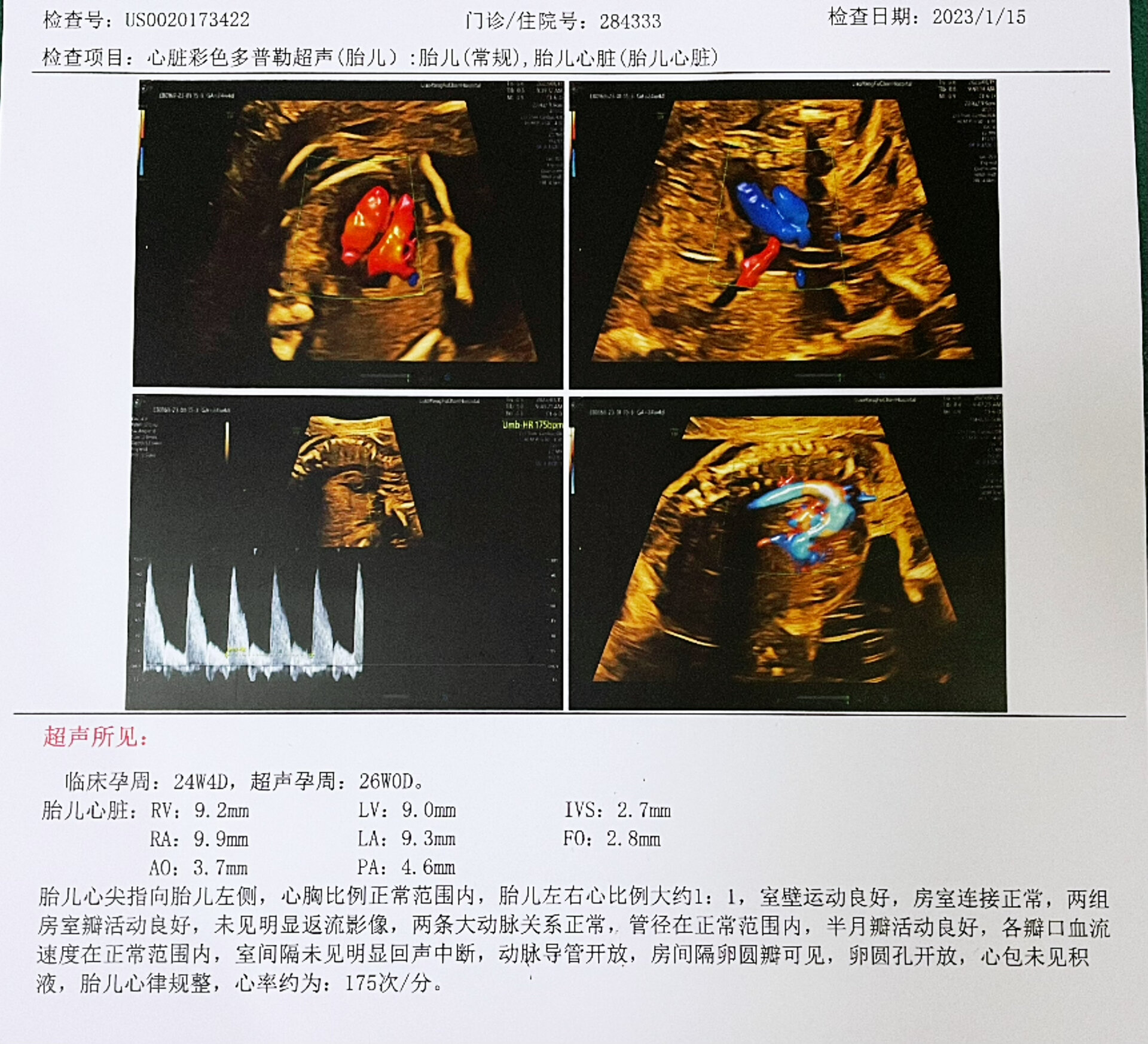 孕期胎儿心脏彩超,检查过程很简单
