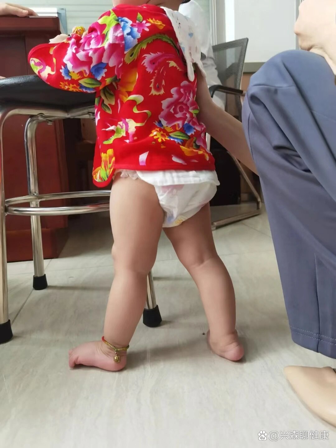 1岁多的小孩,这种脚,叫做仰趾外翻足!