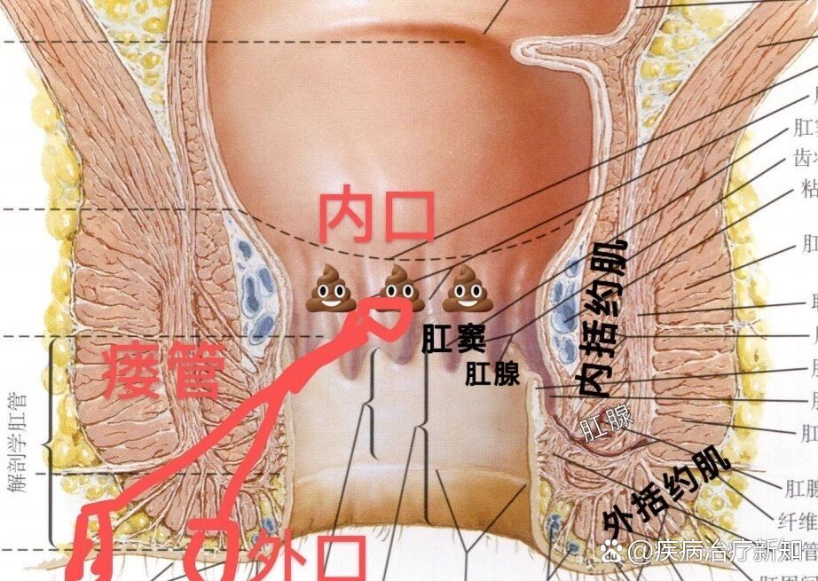 肛瘘瘘管位置图片