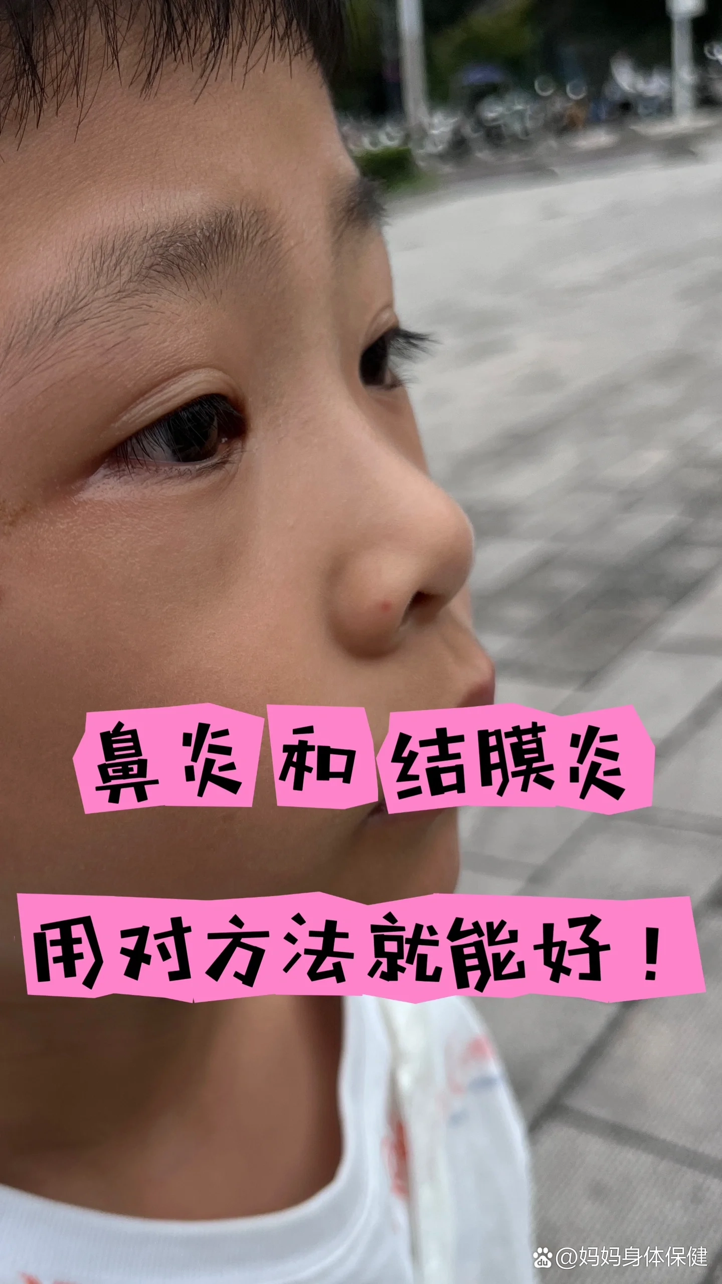 超简单治愈过敏性结膜炎