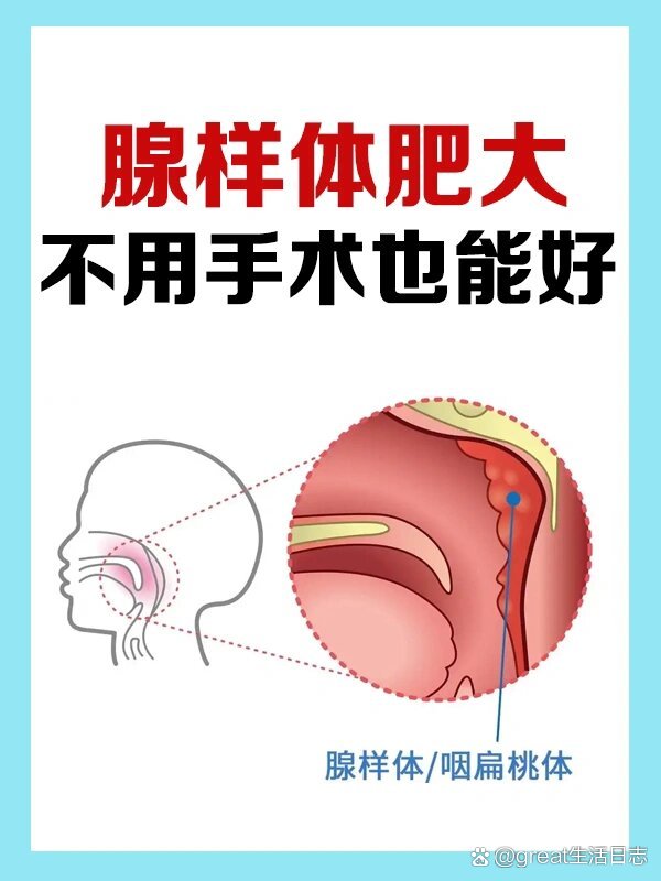 时候已经做了腺样体肥大的切除手术,切除后的一年内孩子确实很少生病