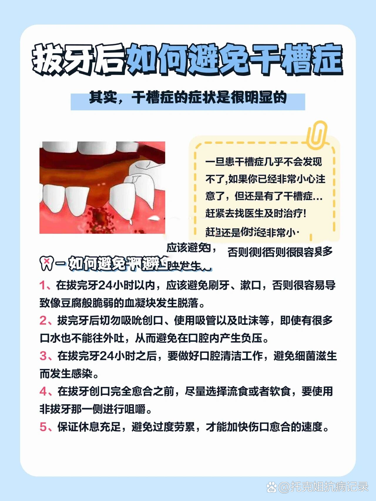 科普干货:拔牙后如何避免干槽症