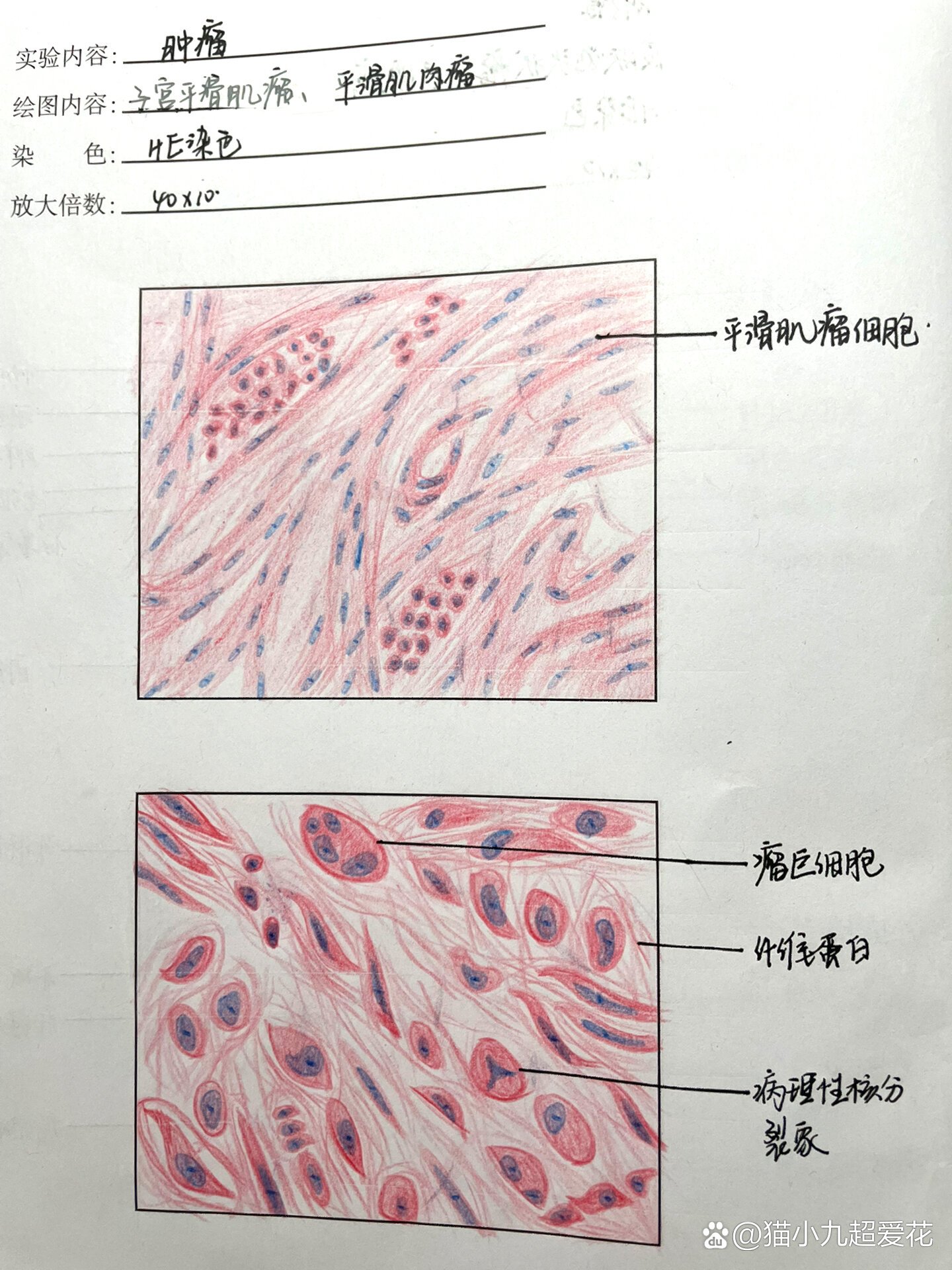 病理学手绘切片分享～p2:子宫平滑肌瘤p3:平滑肌肉瘤1