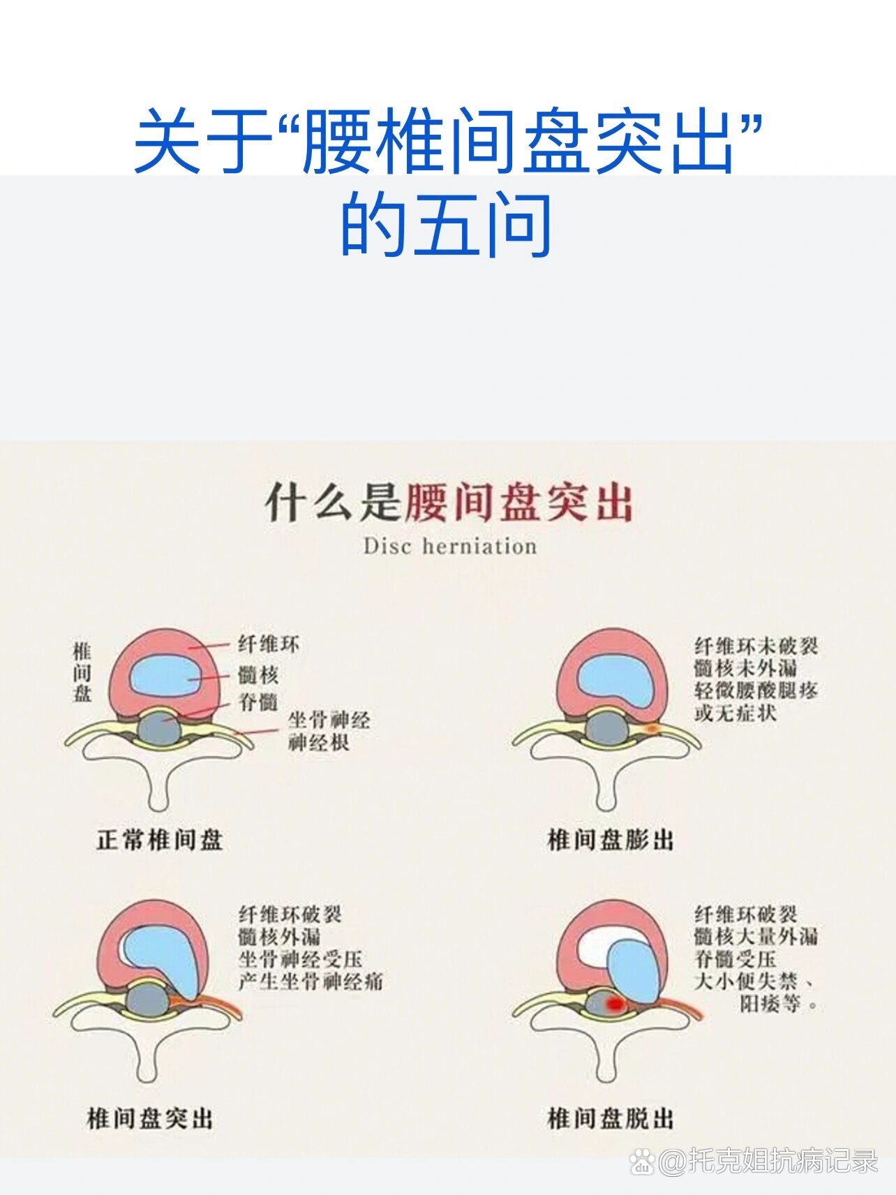 郭晶晶腰椎间盘突出图片