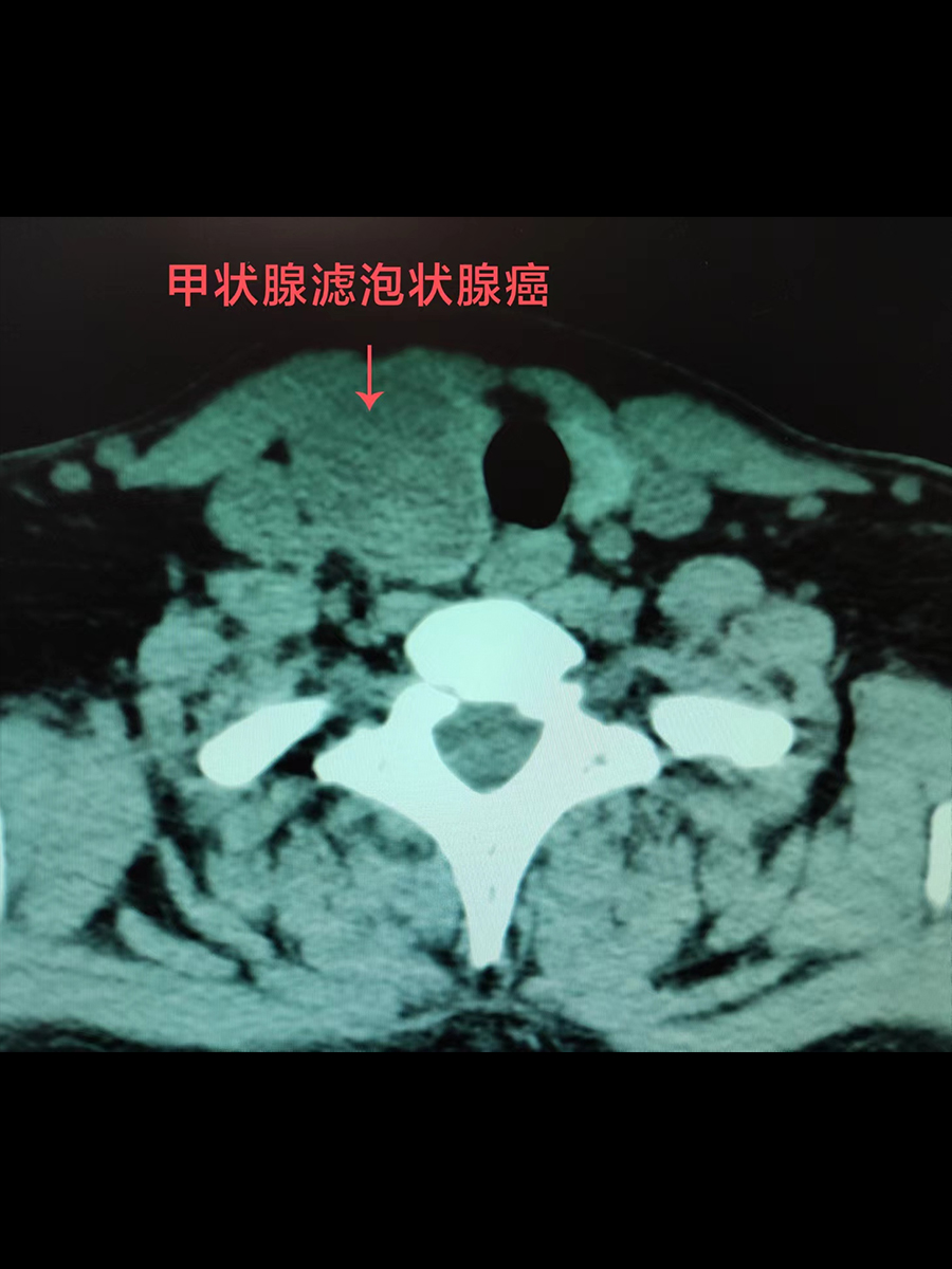 甲状腺癌ct表现图片