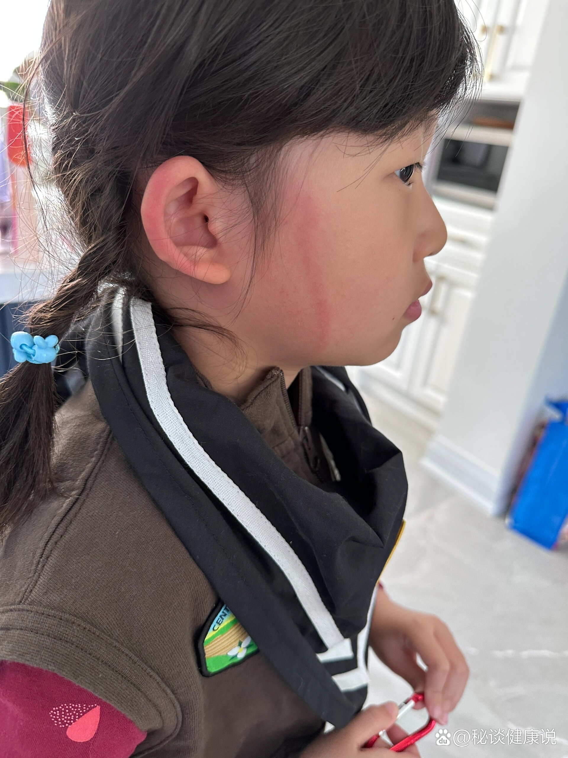 孩子脸上出现一道红印,不疼不痒,刚开始的时候微微有点儿隆起,现在