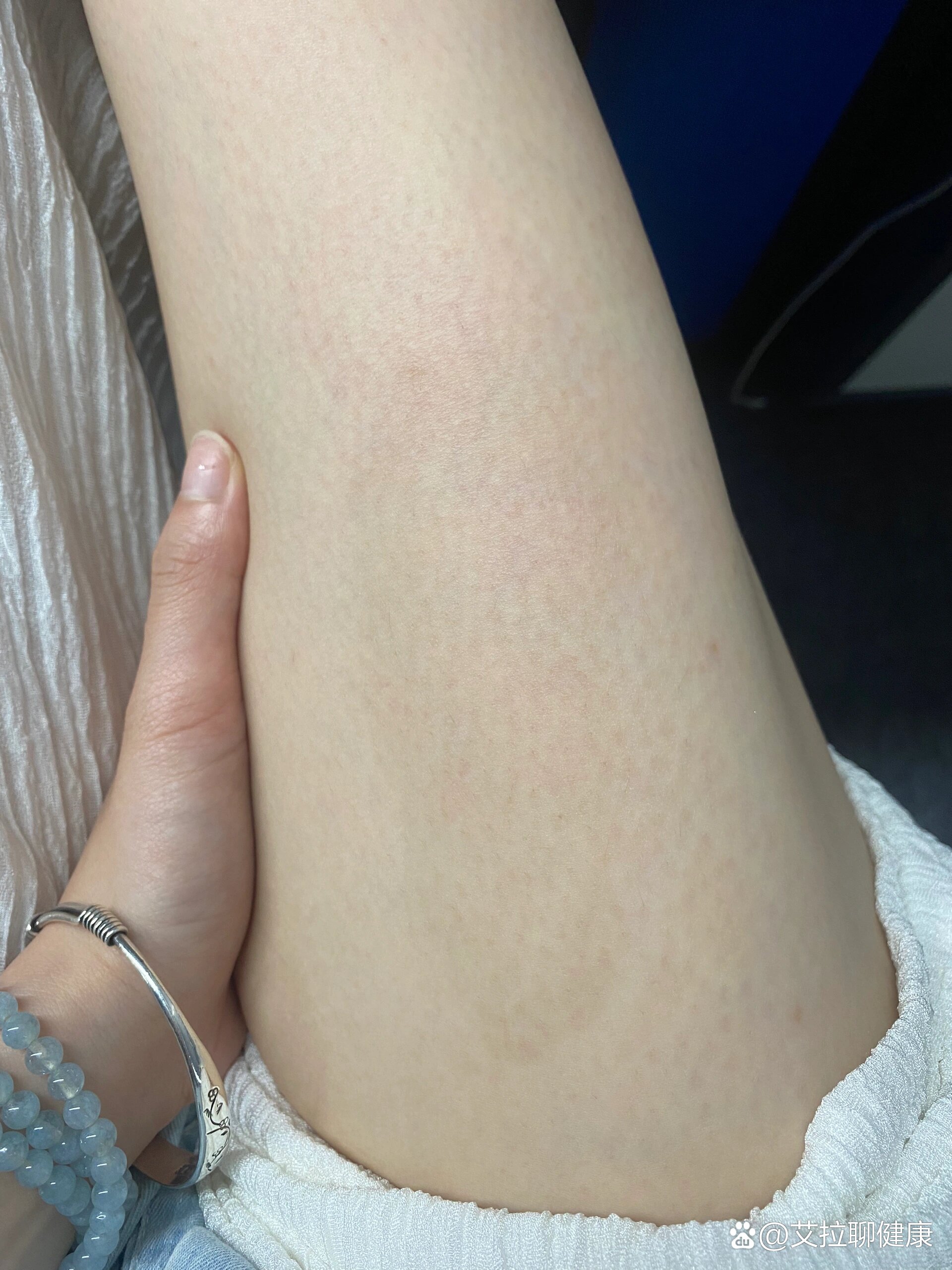 烫伤,黑色素沉淀的一年06615几个月以后