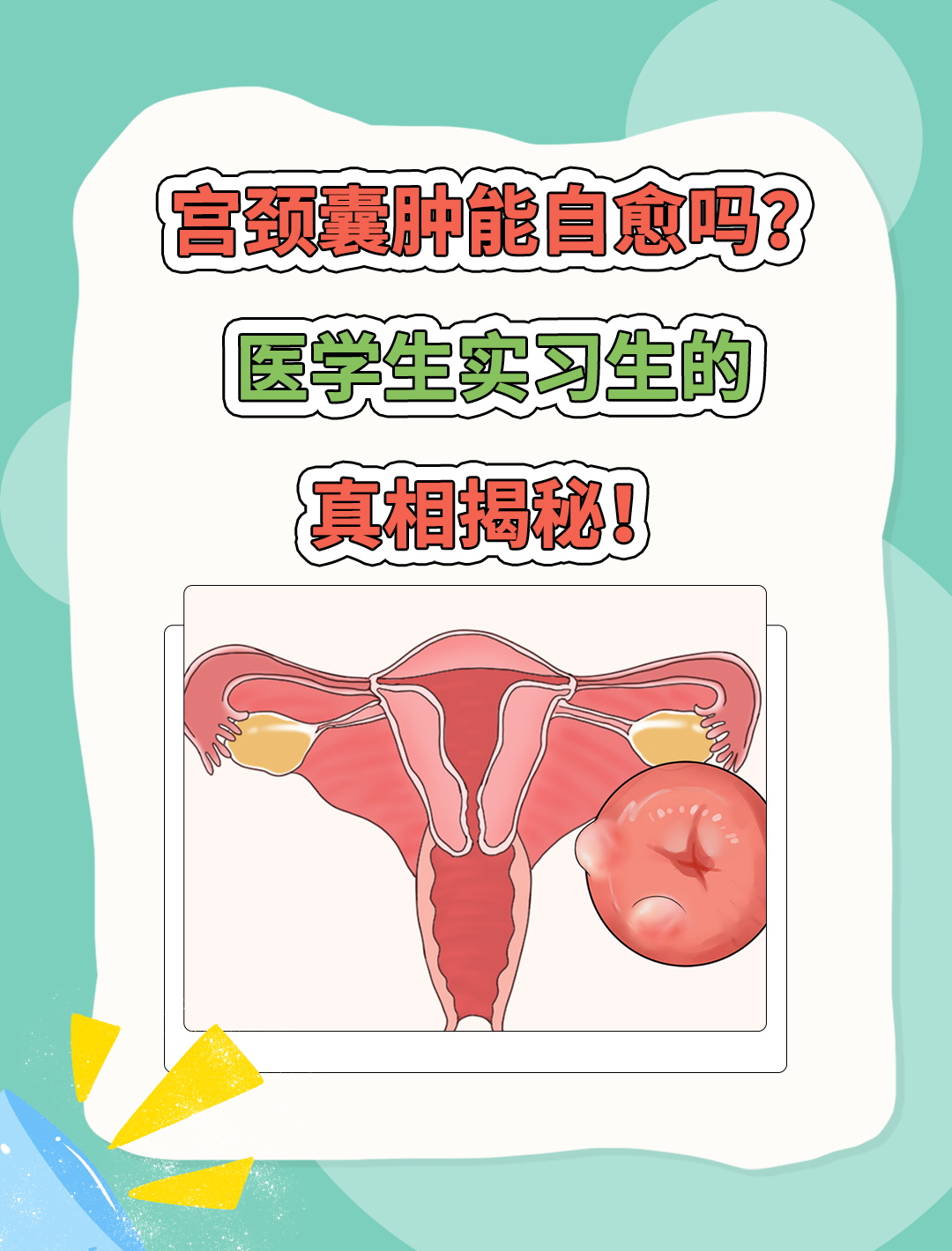 女人宫颈囊肿图片大全图片