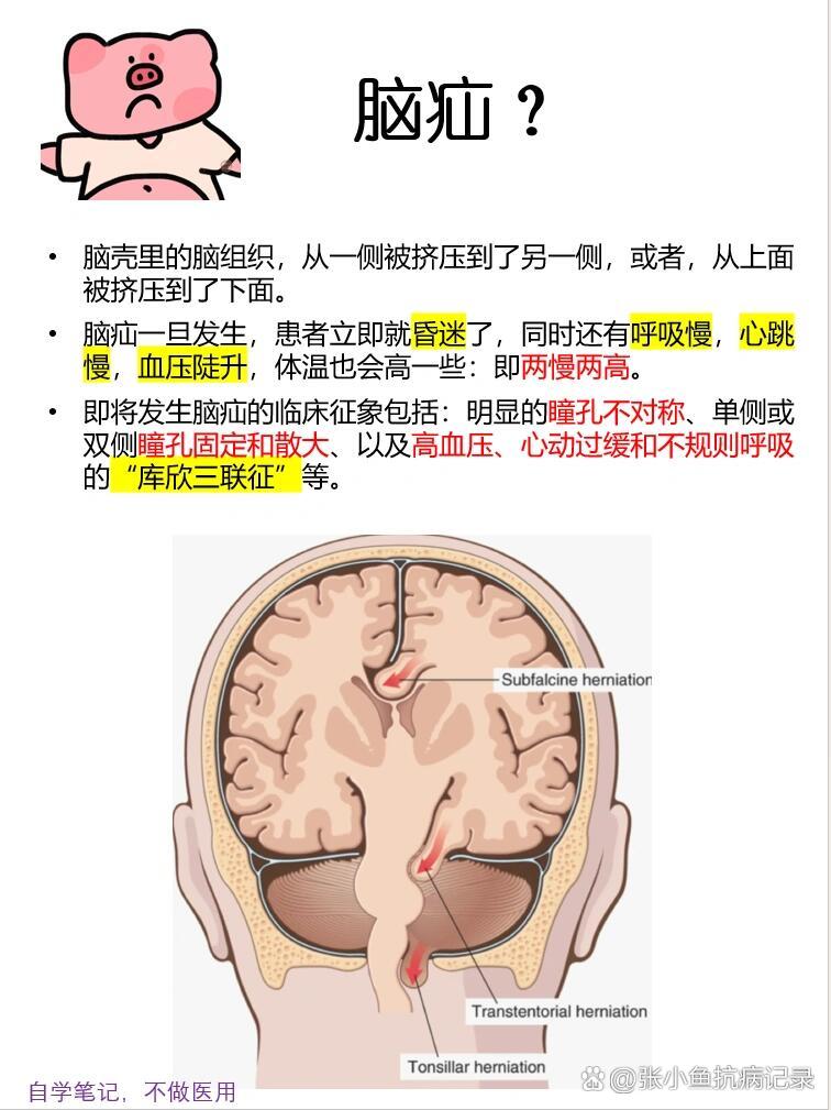 📝|脑疝的表现分类和预防