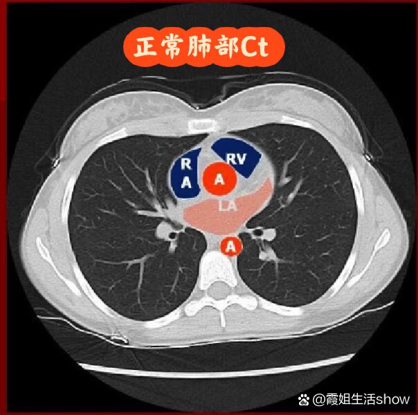 病毒性肺炎ct图片图片