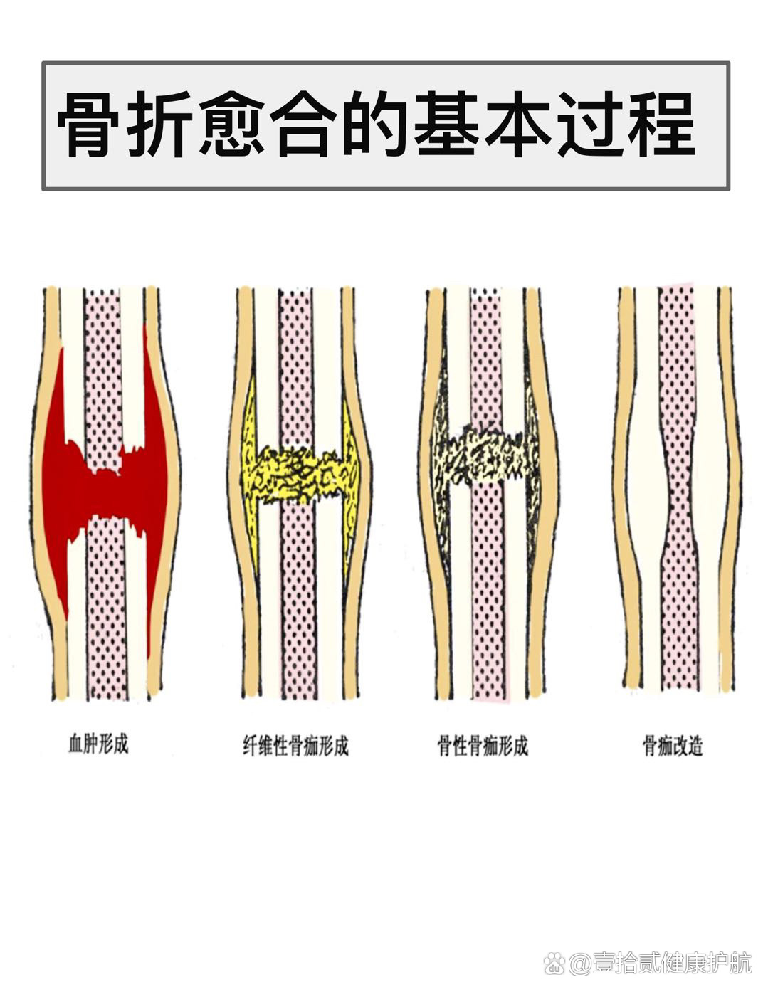 骨头愈合过程示意图图片