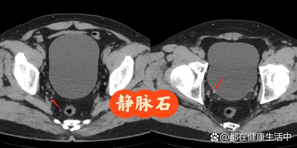静脉石与泌尿系结石