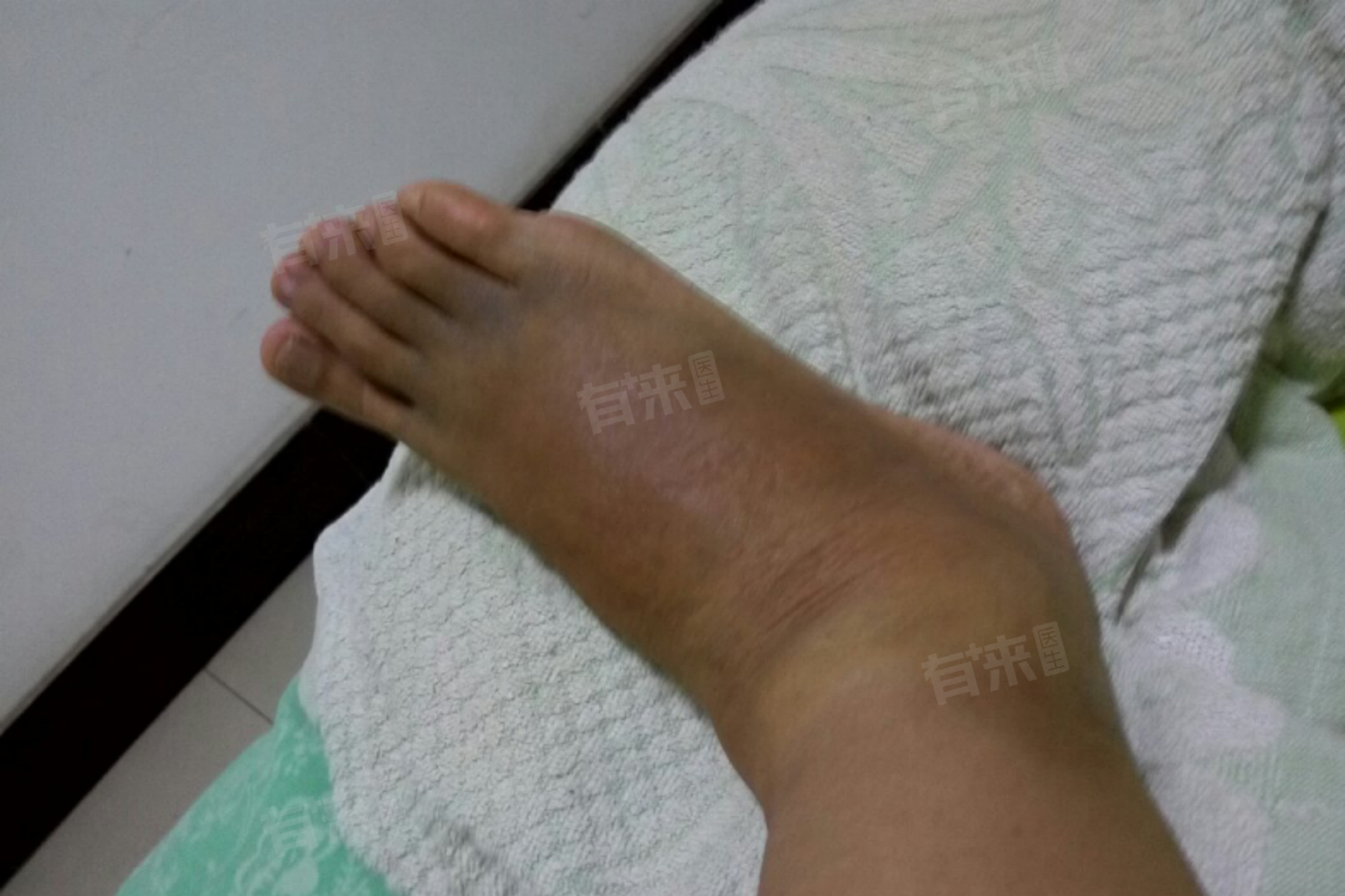 脚砸伤了怎么消肿止痛最快