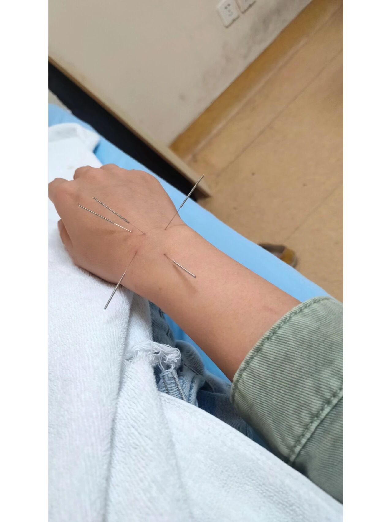 针灸两次,痛了几个月的腱鞘囊肿治愈了