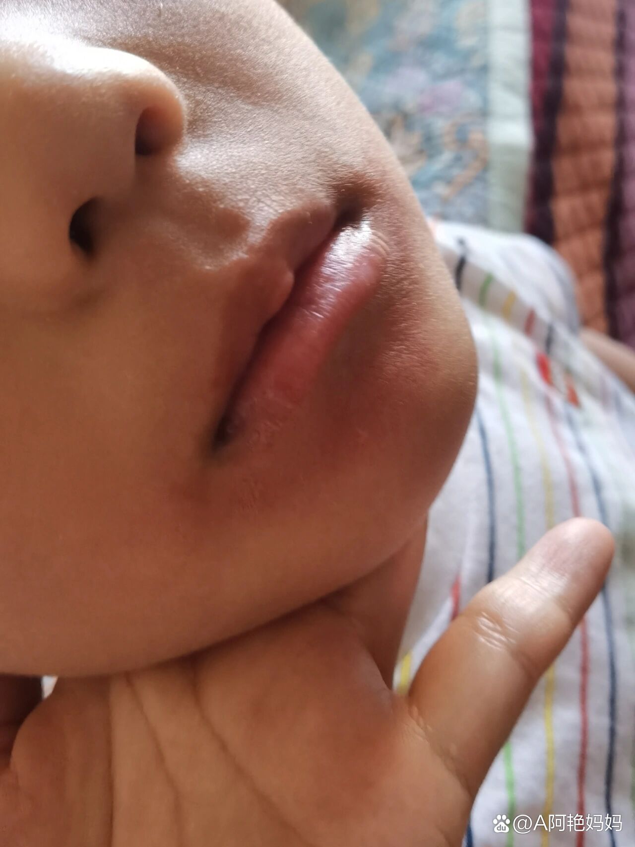 孩子嘴周围红肿,皮肤紧巴巴的,咋回事?