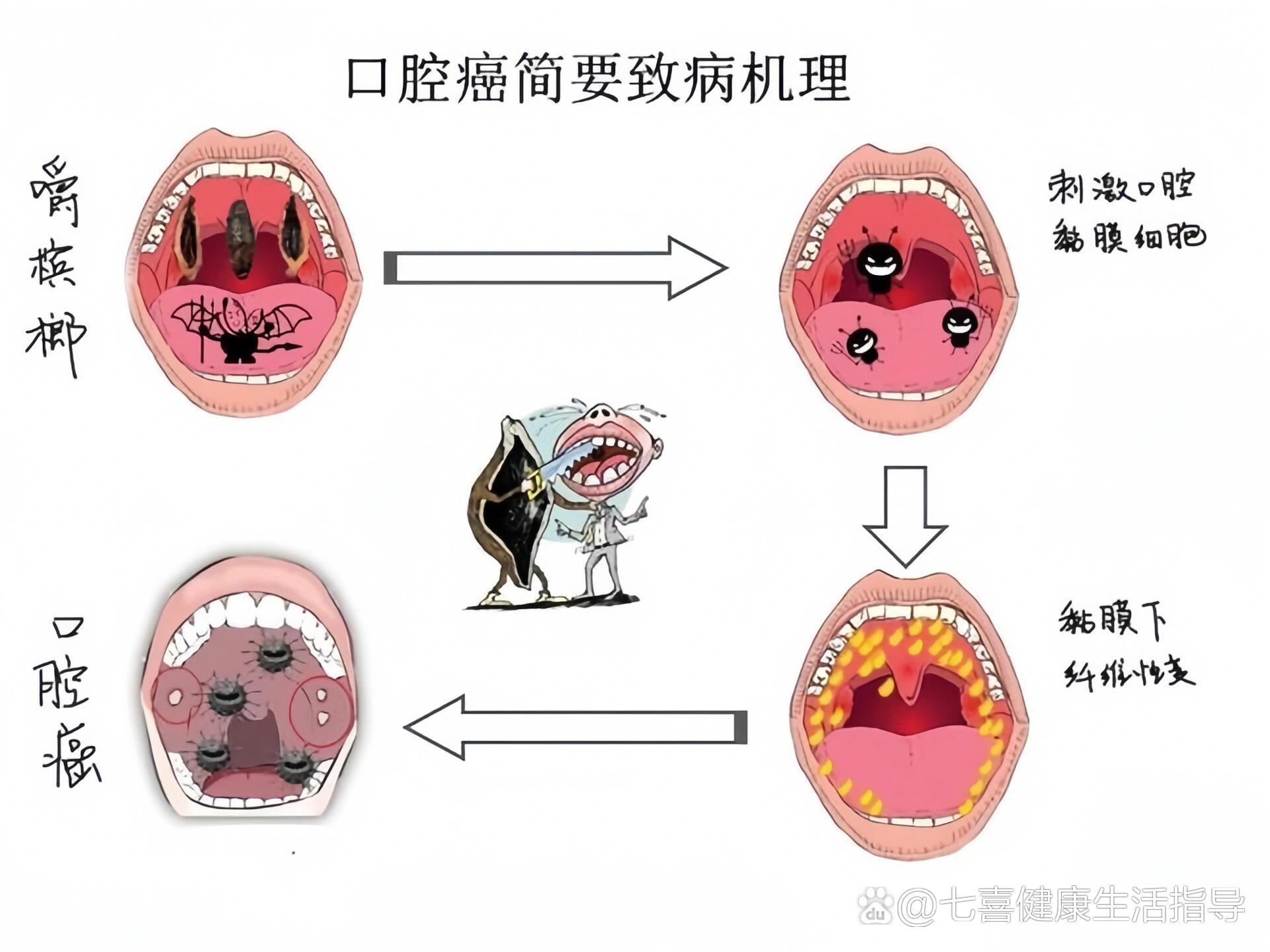 口腔癌的病因