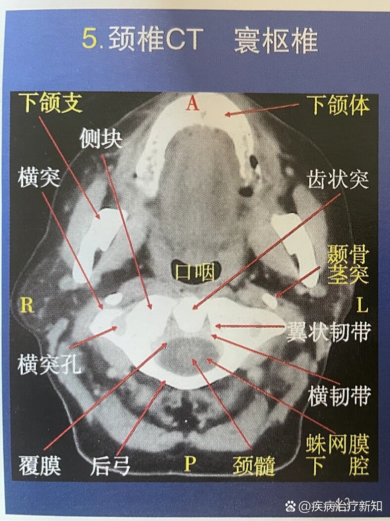 颈3椎体解剖图片