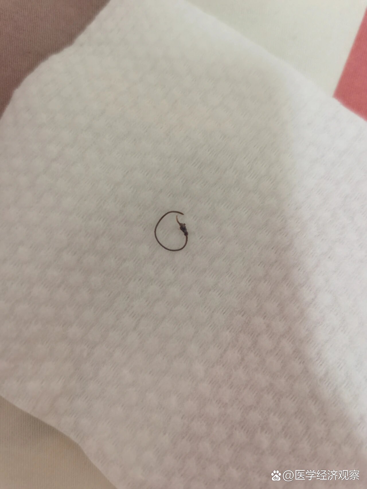 的线到今天一共排出了4根,其中一根如图带线头这样是会慢慢好