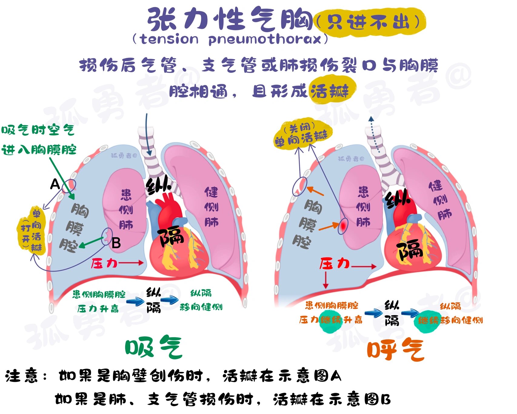 开放性气胸图片解释图片