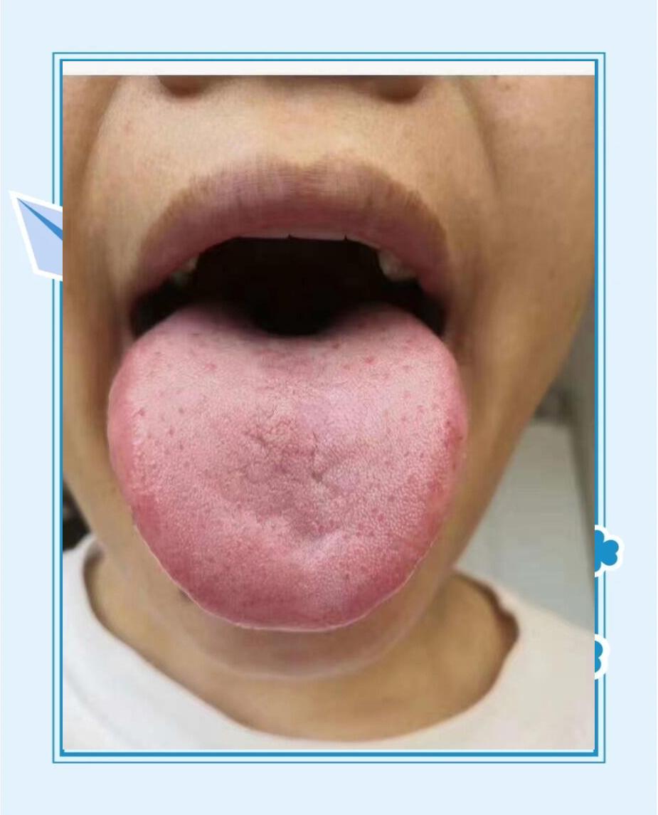 👅舌诊秘籍：二十种舌象解析