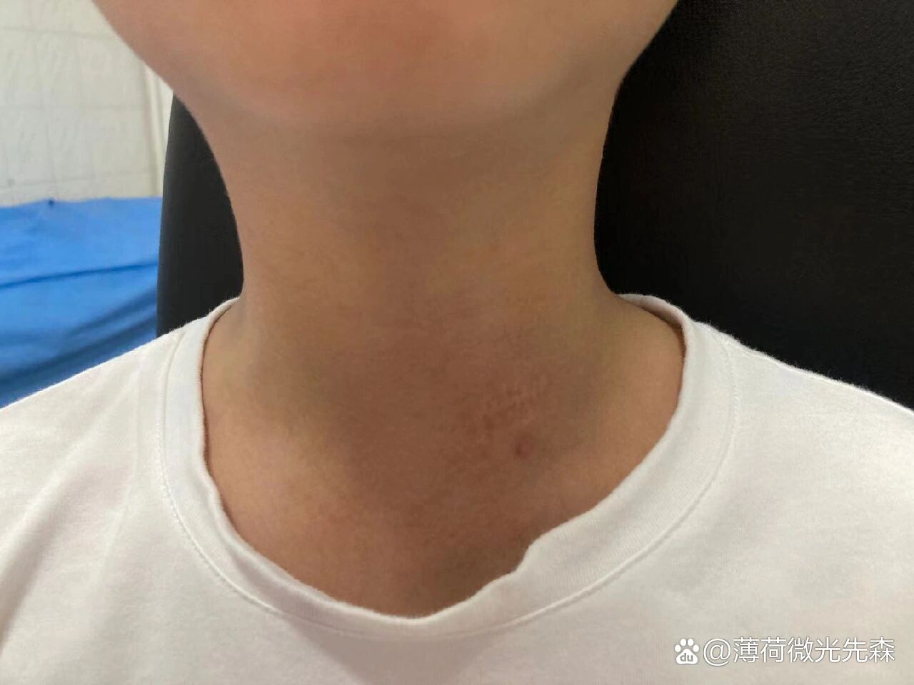 梨状窝瘘的患者