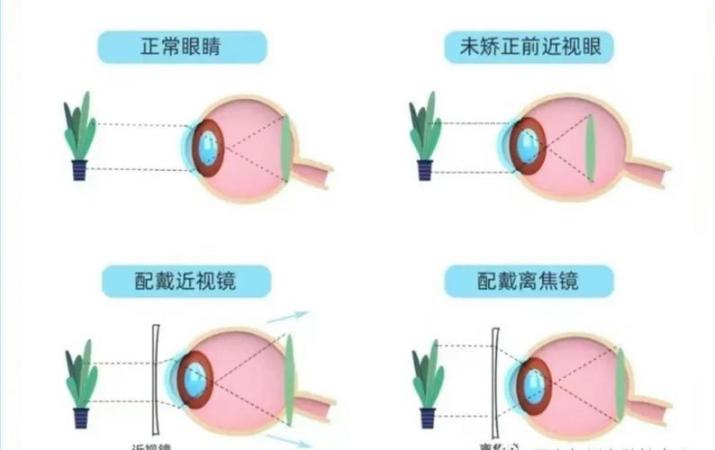 离焦镜片与普通镜片的三大区别