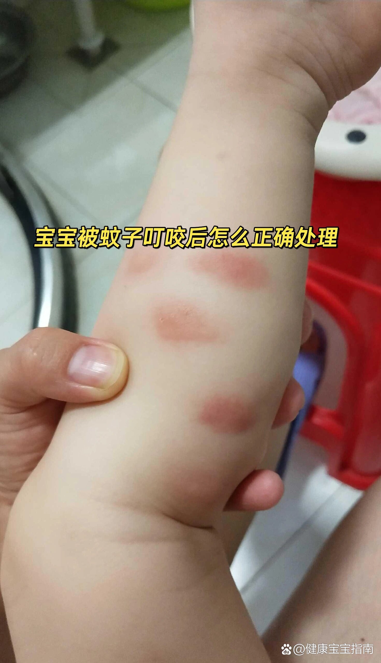 被蚊子咬了痒怎么快速止痒为什么在线