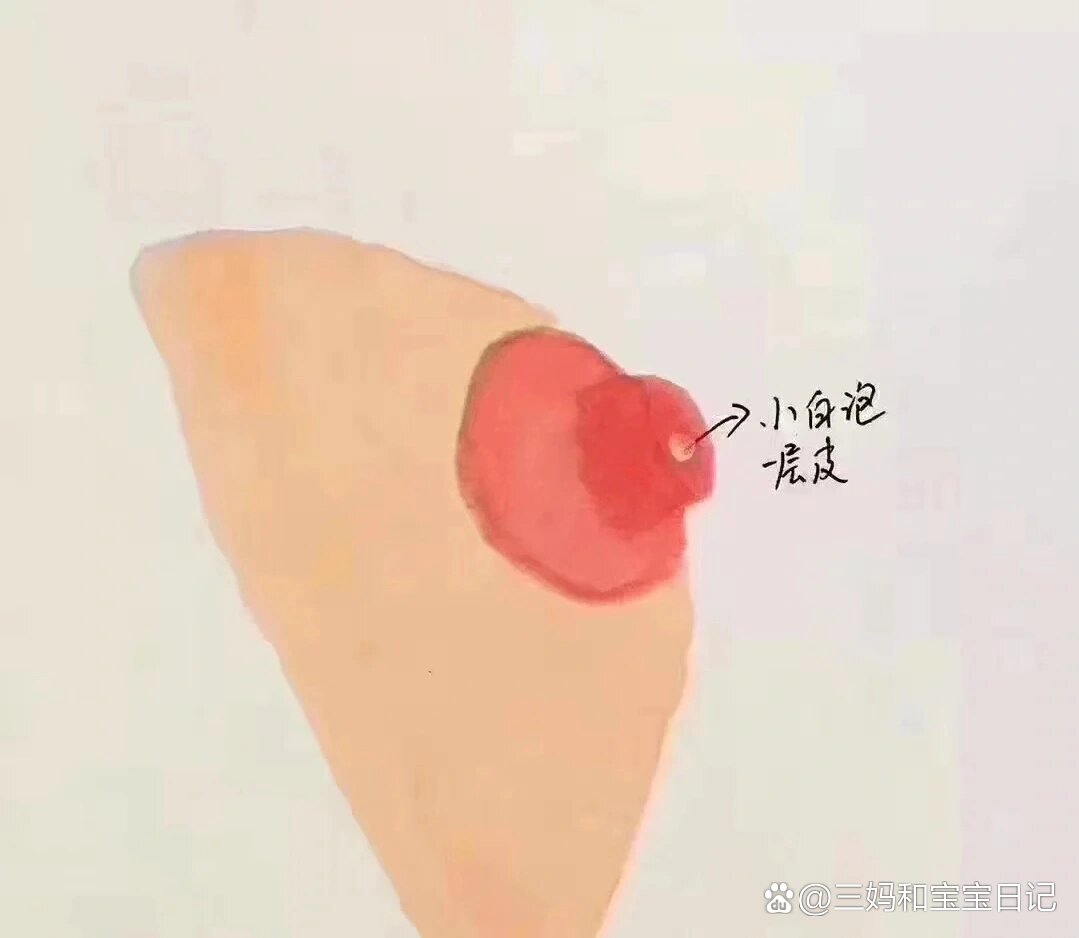 5岁宝宝乳头突出图片