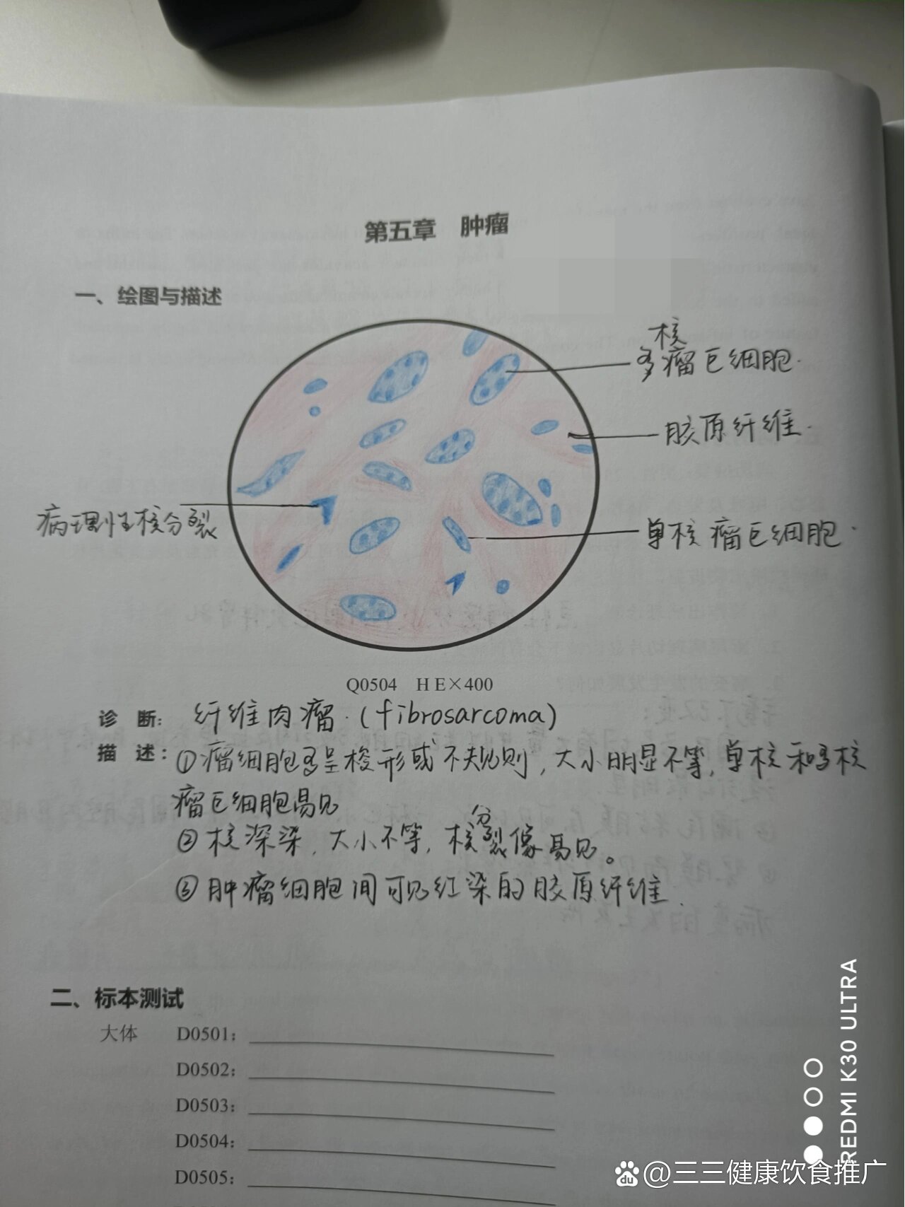 乳腺纤维腺瘤病理绘图图片