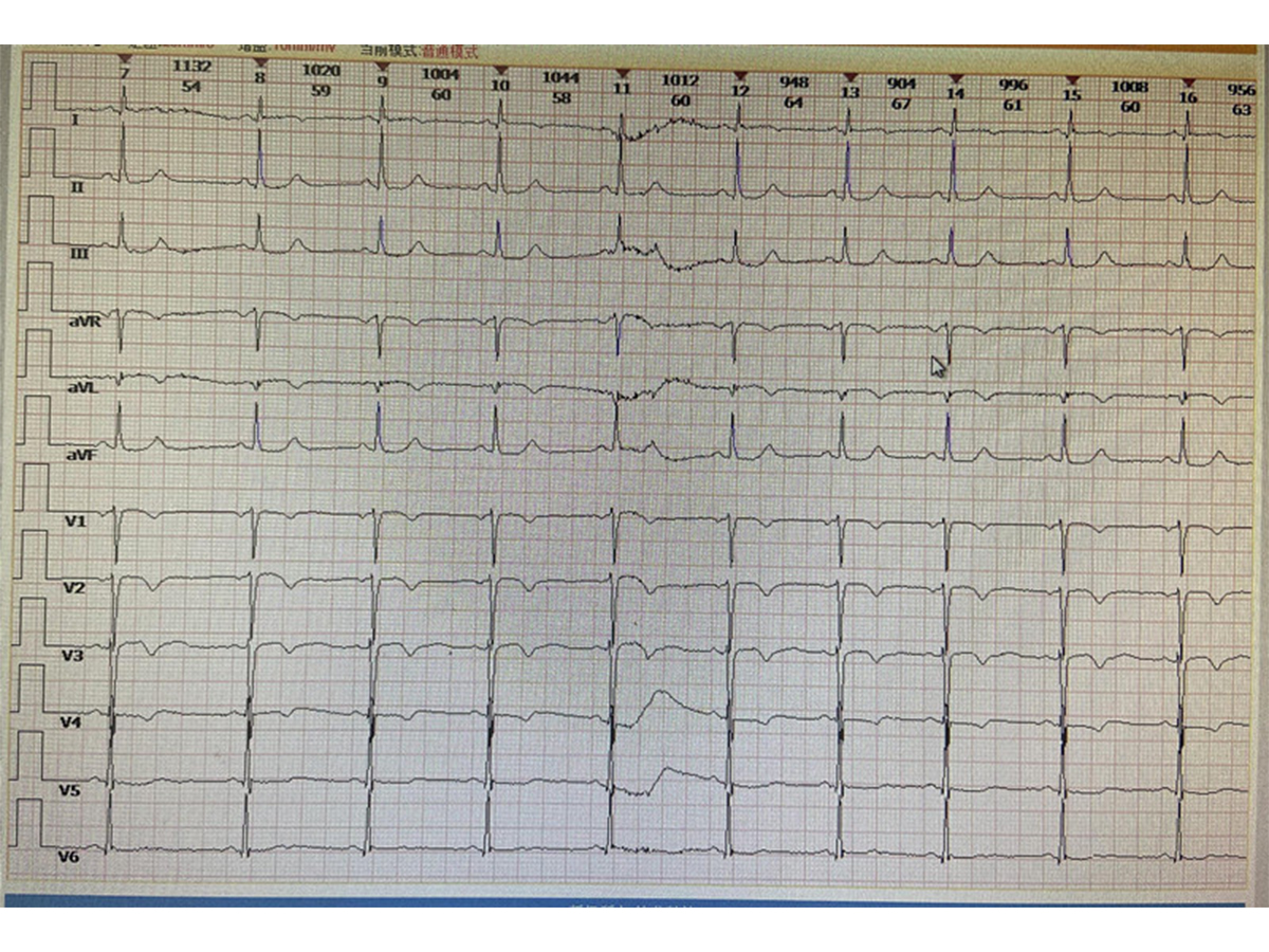 心绞痛发作心电图图片