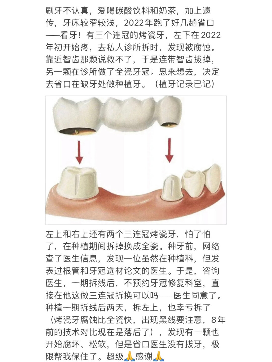 2022左上烤瓷三连冠换全瓷