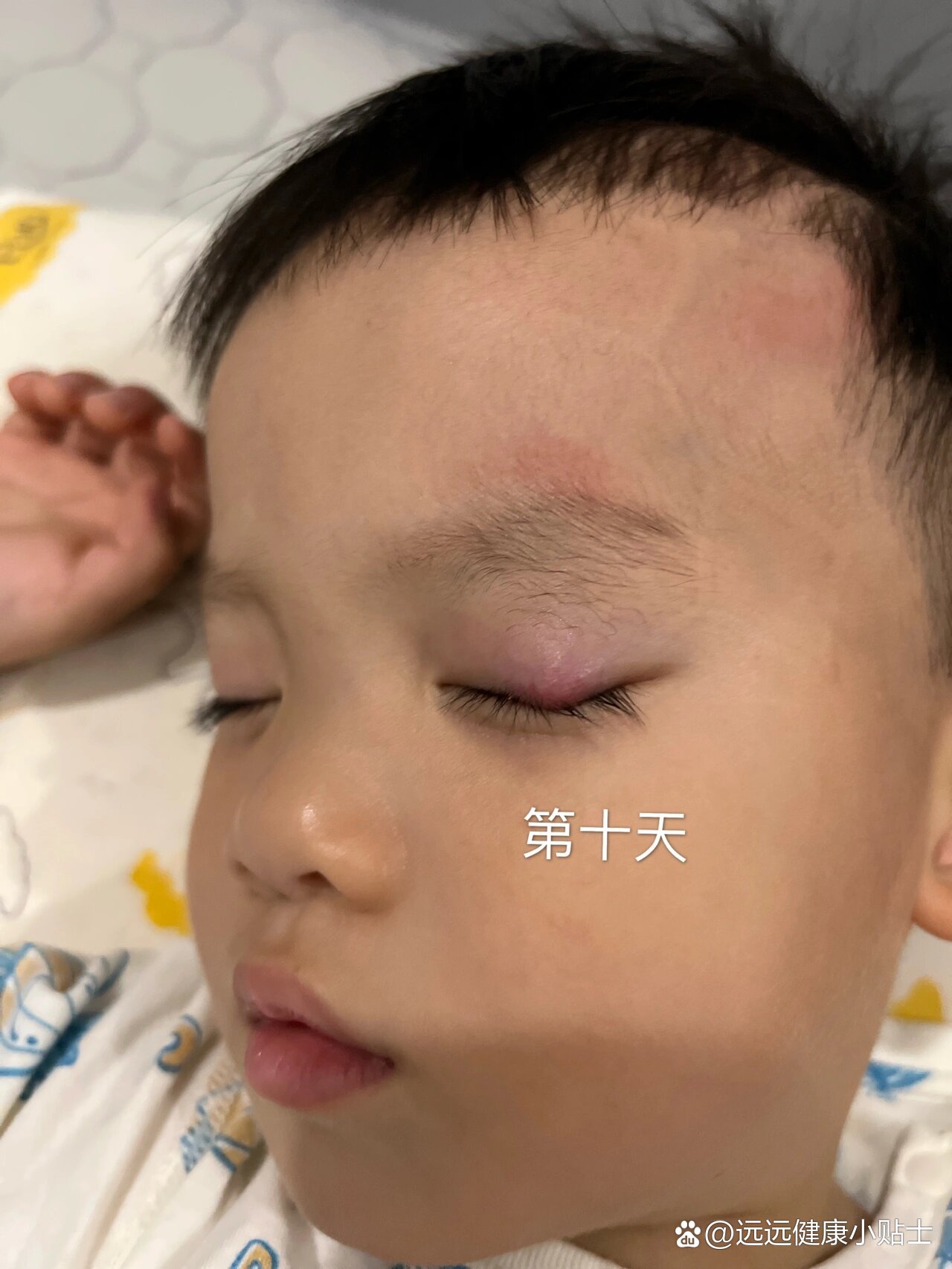 霰粒肿,热敷热敷