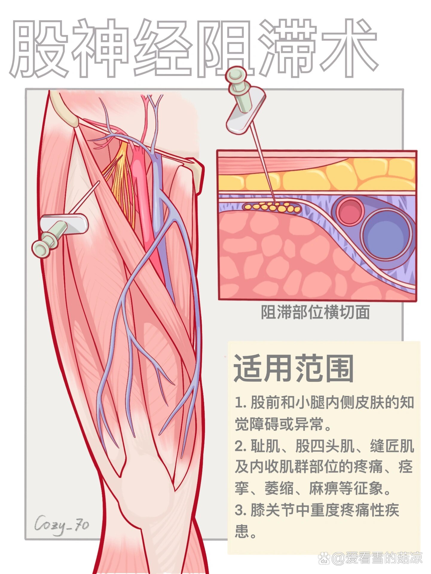 髂筋膜阻滞ppt图片