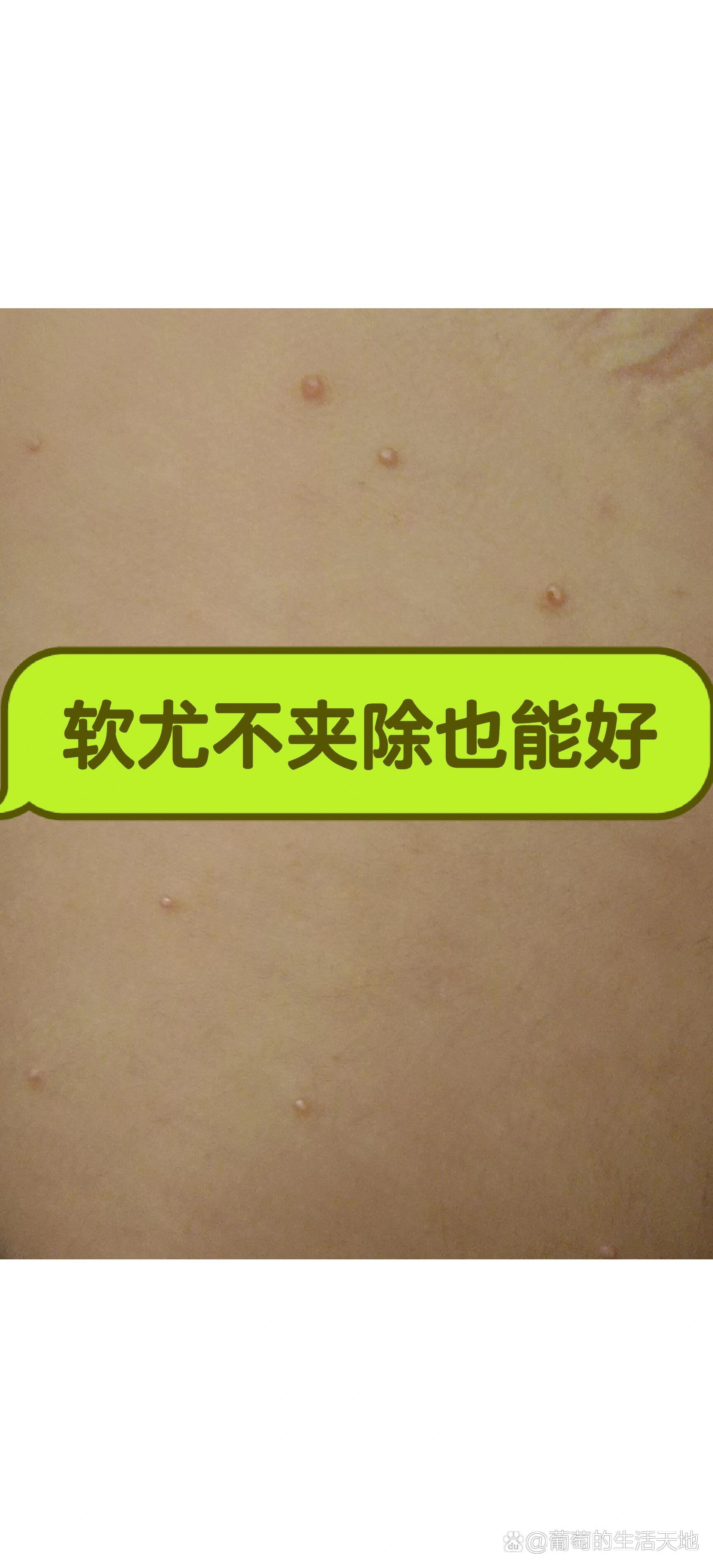 软疣只能夹除冷冻吗?