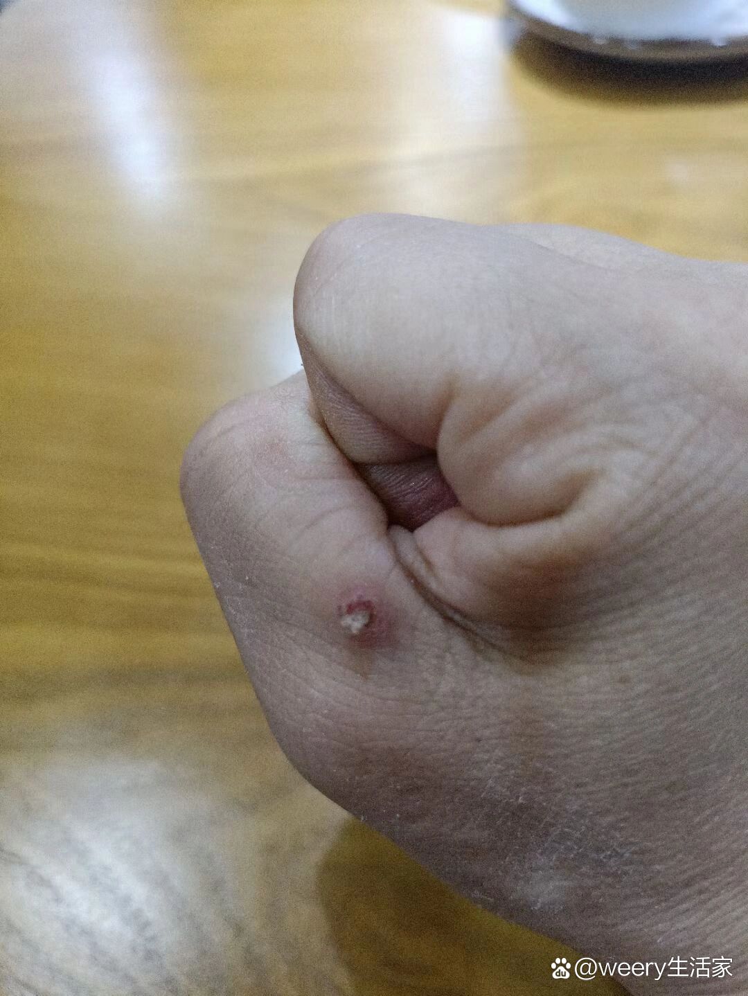 克疣液
