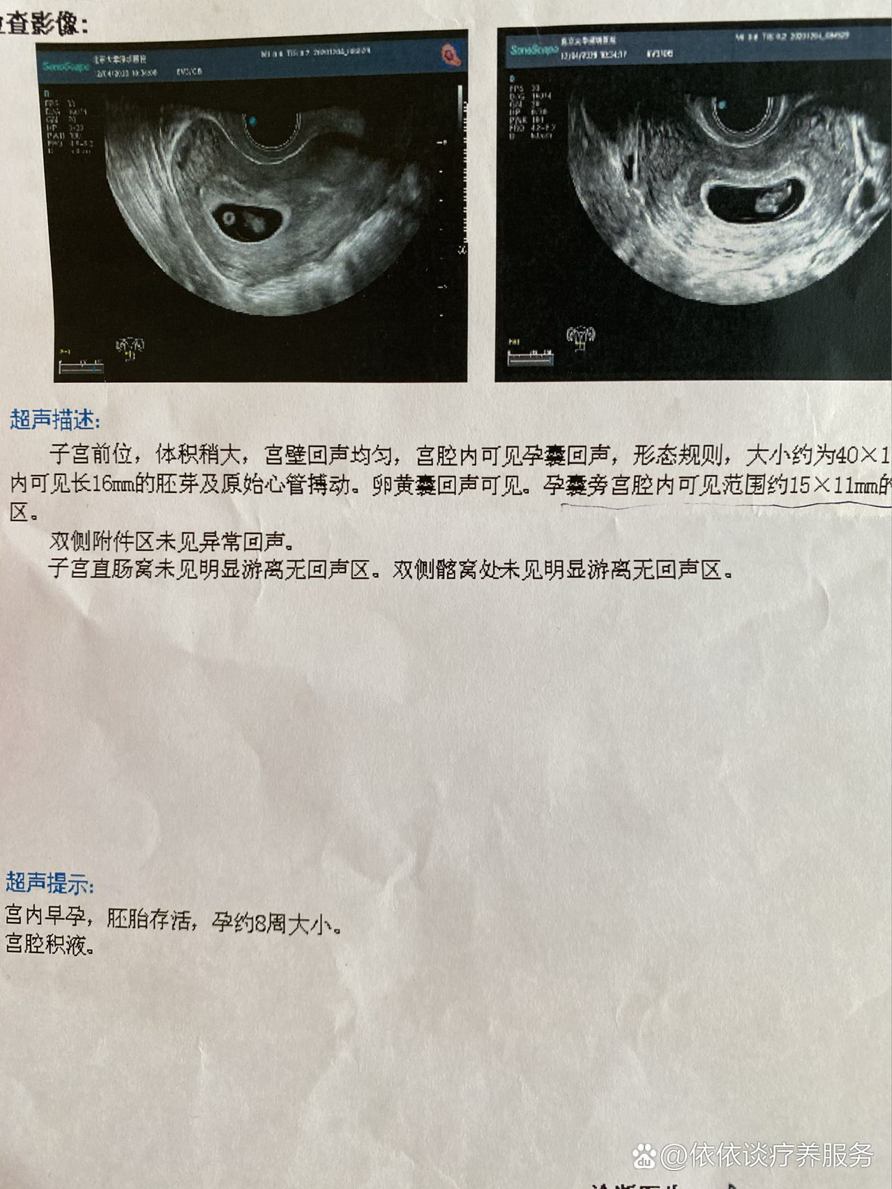 孕8周宫腔积液怀孕8周了,去医院检查,孕酮和胎儿都是正常的,就