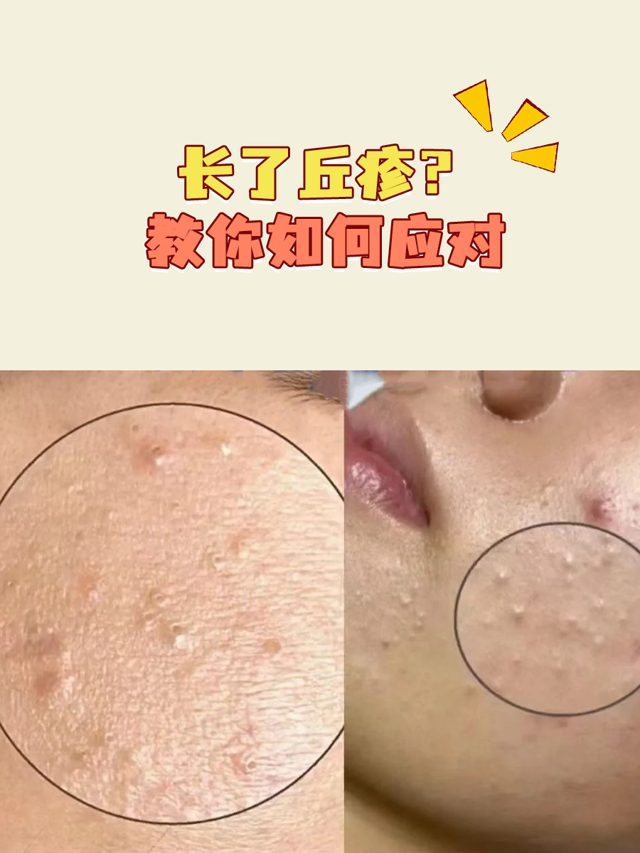 长了丘疹?教你如何应对