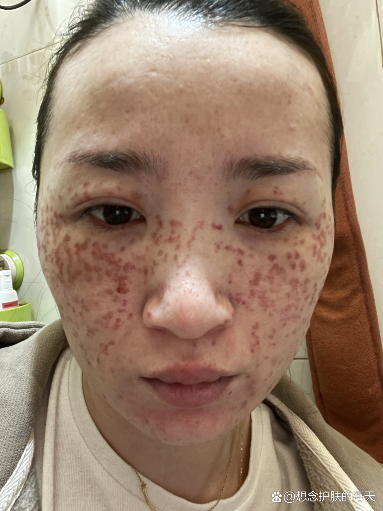 激光祛斑后的第二更