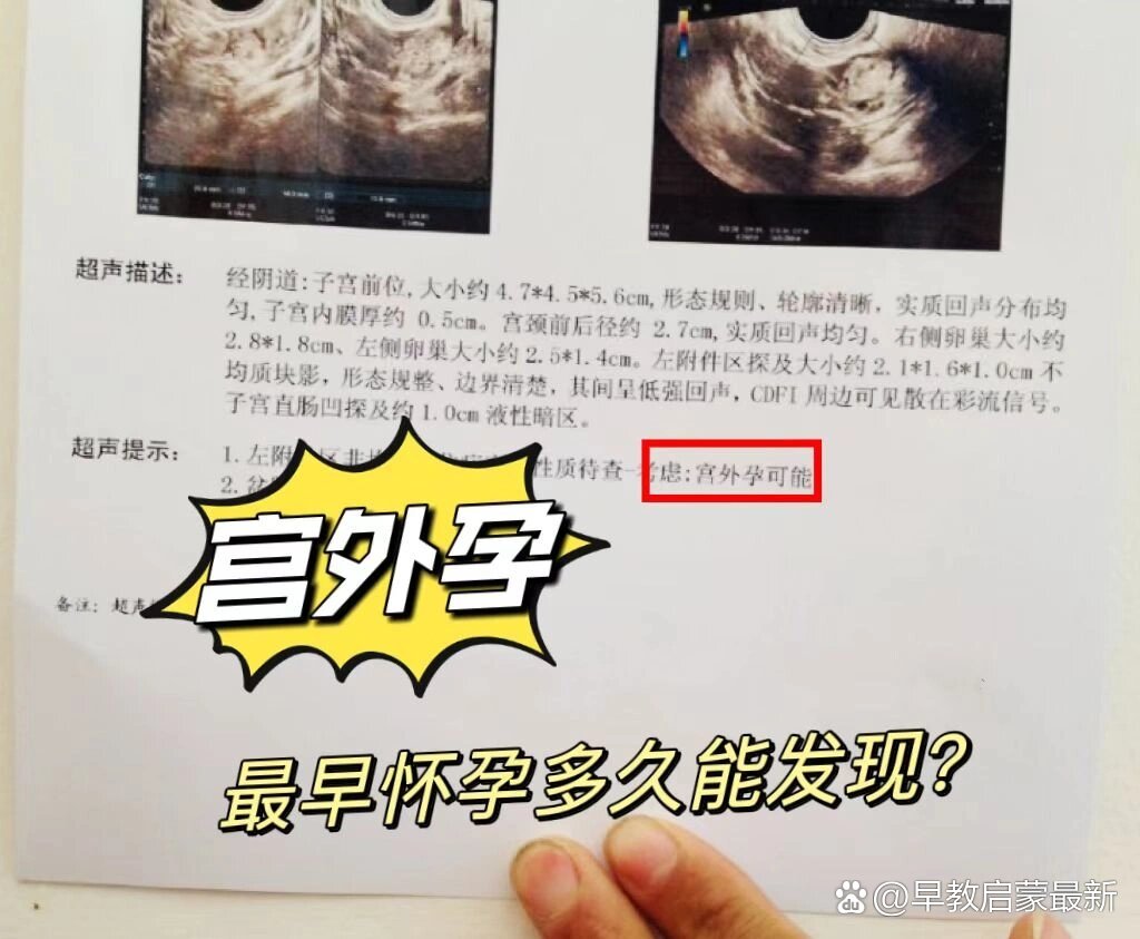 宫外孕,最早怀孕多久能发现?