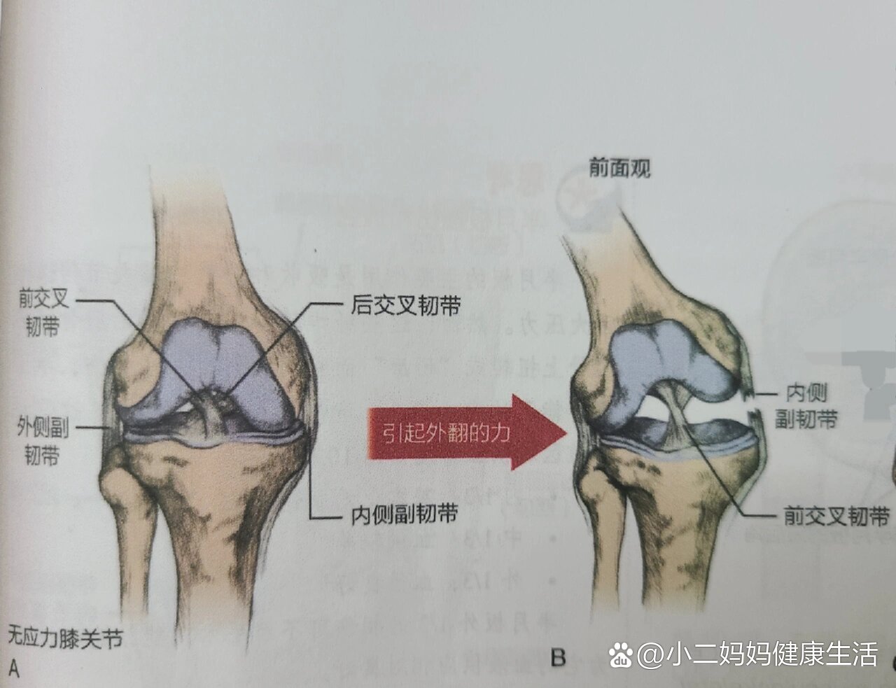 膝关节外侧副韧带位置图片