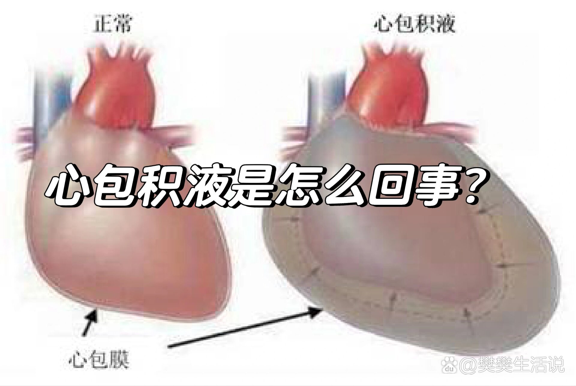 心包积液图解图片