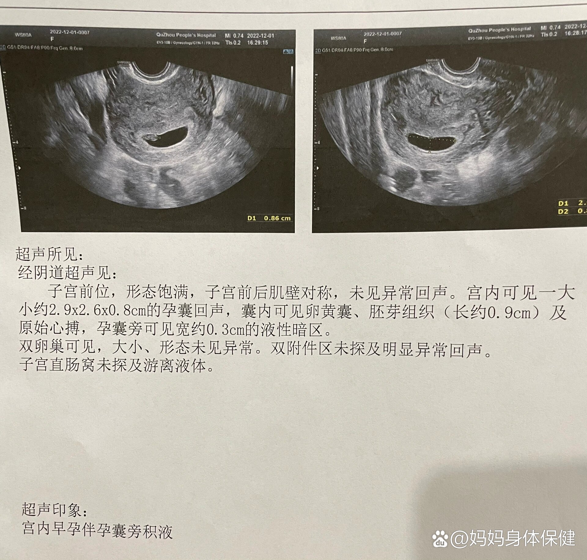 孕26周胎心位置图片图片