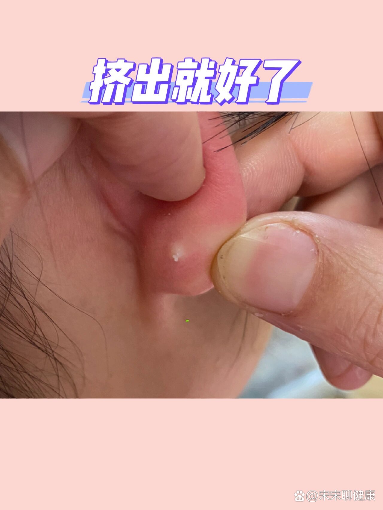 多年耳洞有硬块