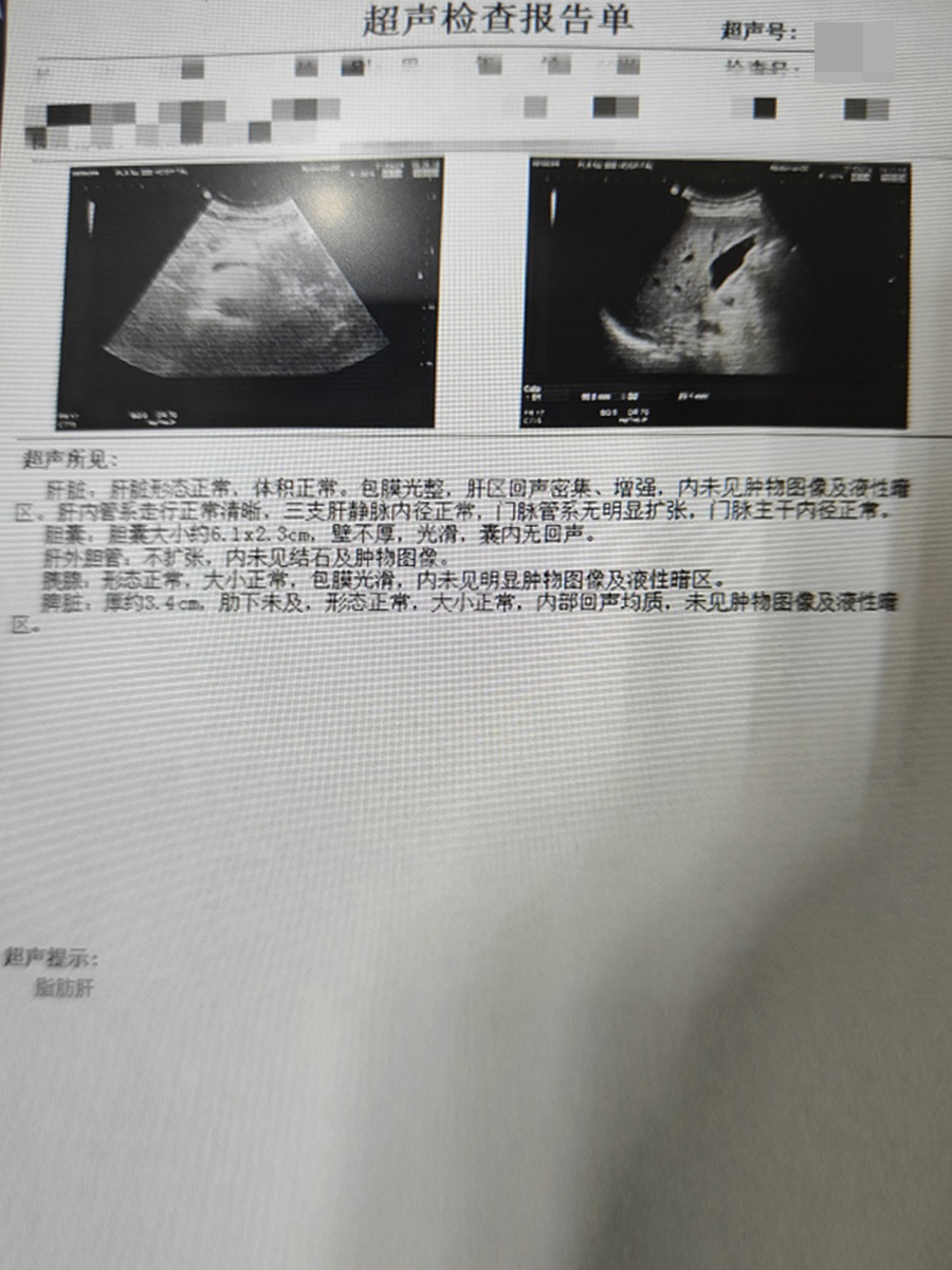 52岁大叔患非酒精性脂肪性肝炎,控制体重很关键