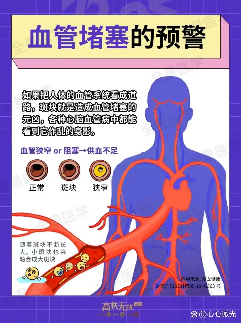 血管堵塞的10大前兆