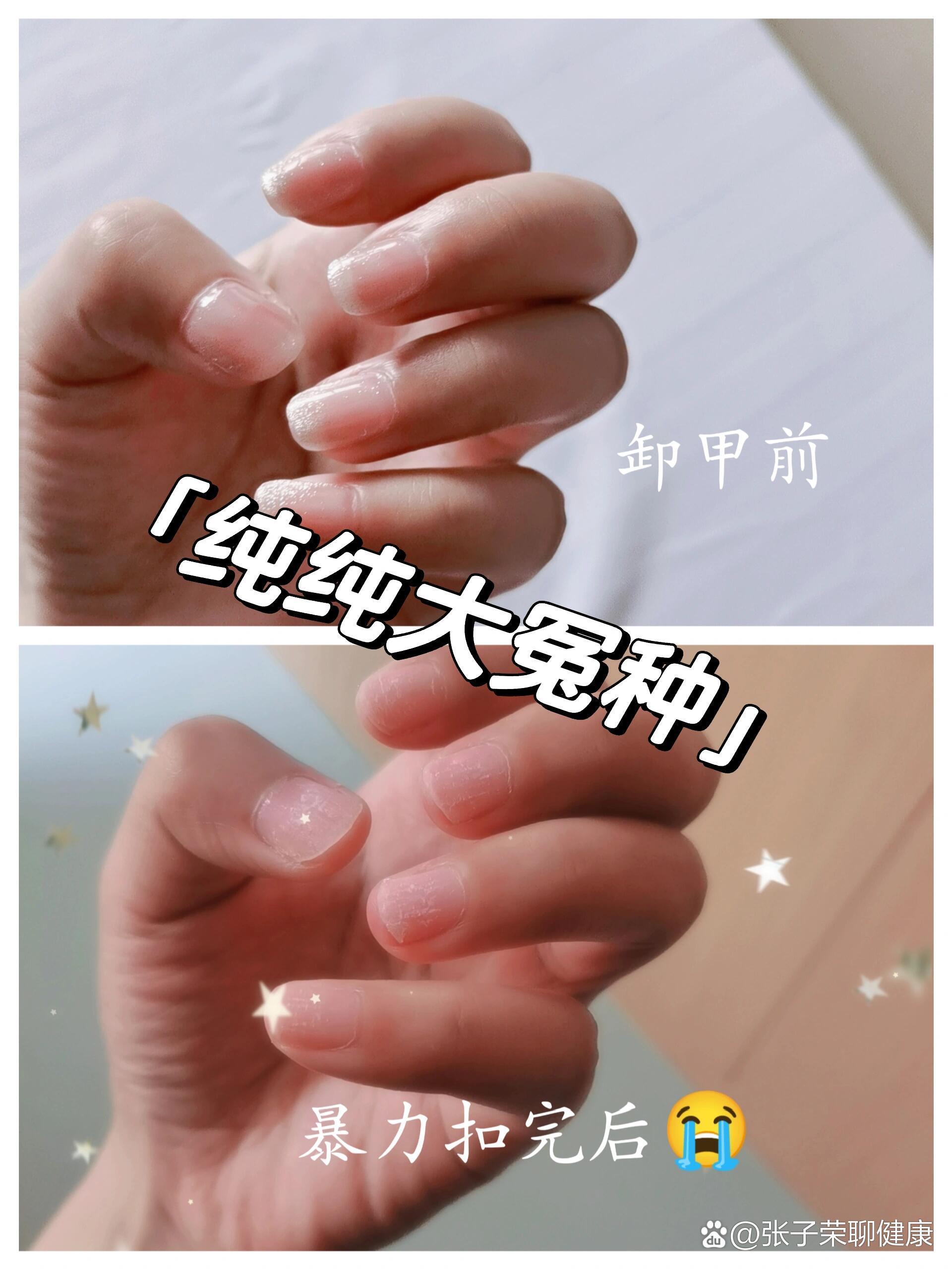 鼻中隔偏曲矫正术后