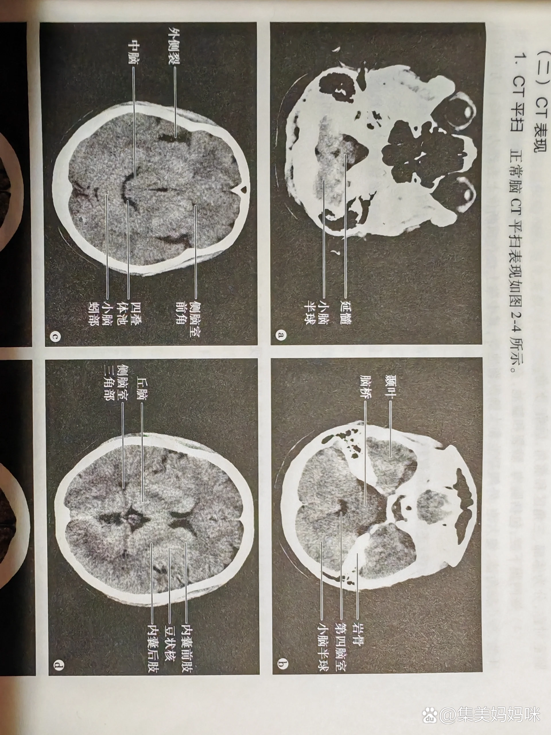 脑ct图图片