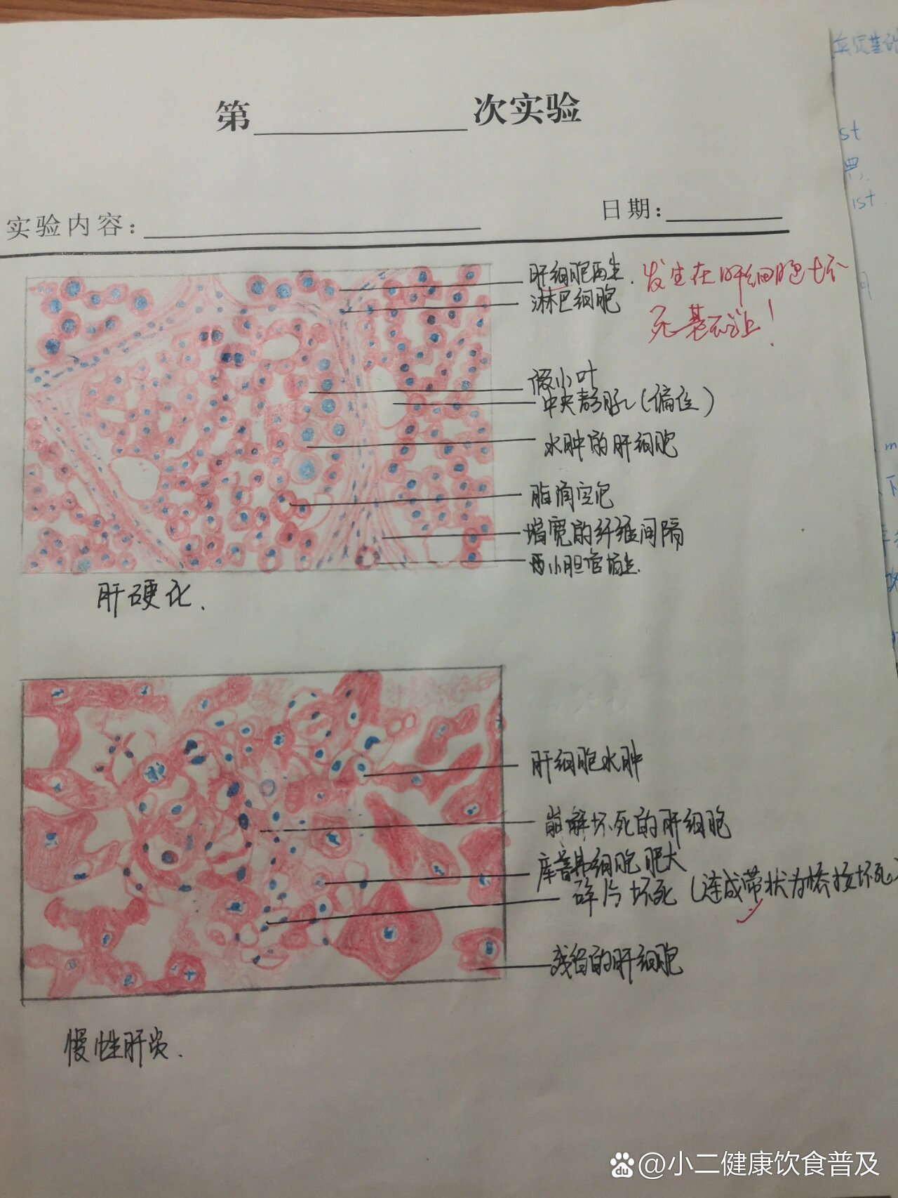 肾脓肿切片绘图图片