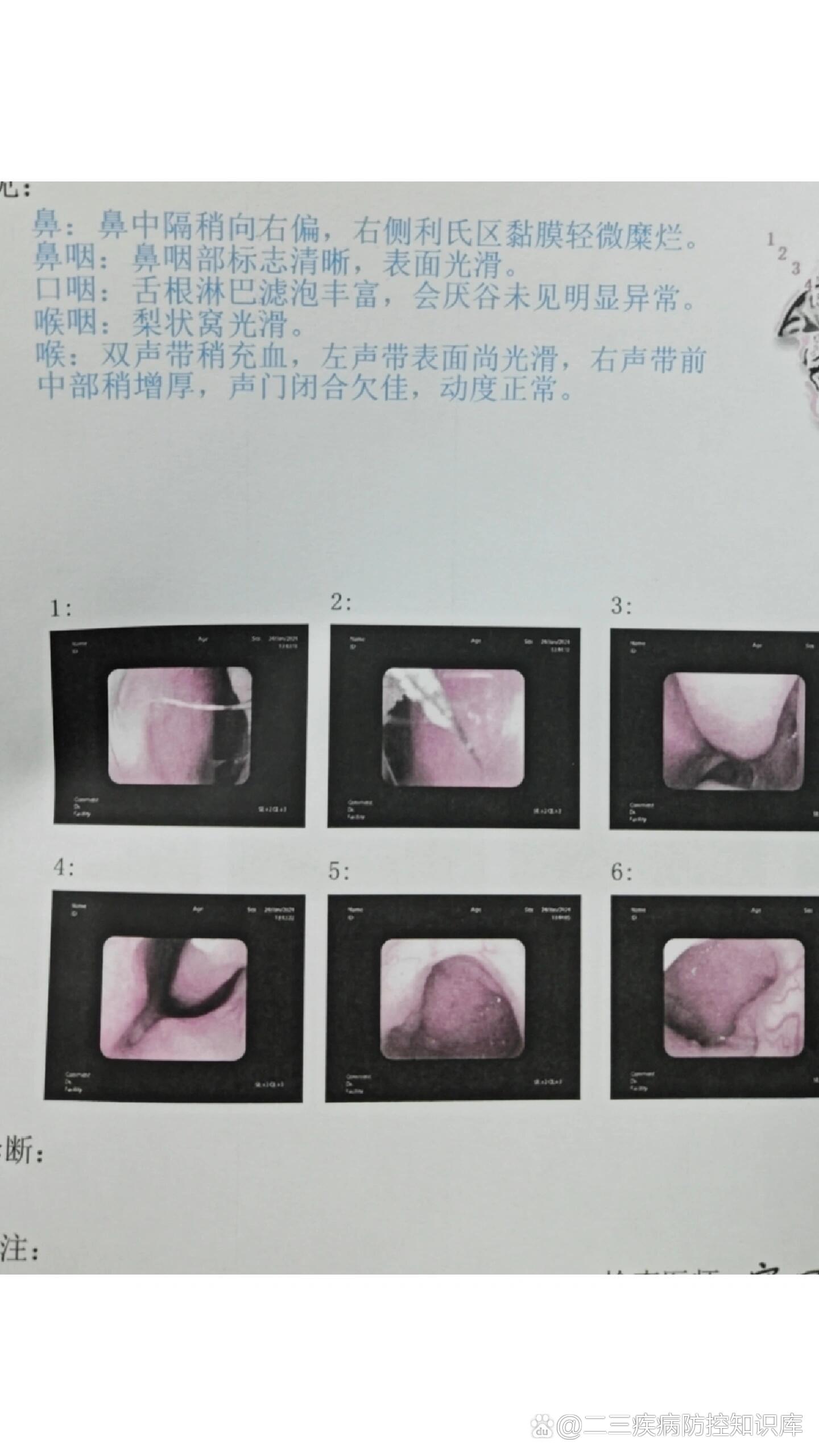 喉咙痛声音嘶哑一个多月在县医院检查做喉镜,由于怕痛,被吓哭了,其实